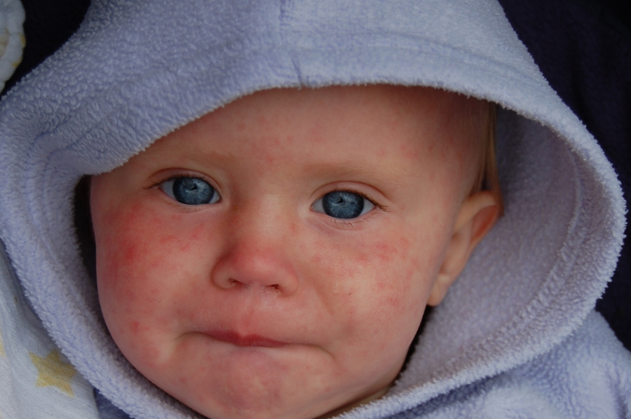 Relying heavily on their parents, this baby suffers from the measles virus along with many others across the United States today. In order to make sure you are safe from this disease, update your vaccinations as they are important to you along with the ones you are closest to. 